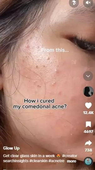 Kombinasi beras dan 1 bahan pemanis bisa atasi jerawat serta komedo di wajah Berbagai sumber