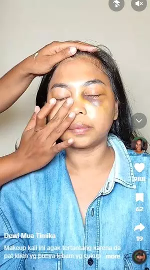 Transformasi wanita dengan lebam di wajah ini hasilnya auto mulus TikTok