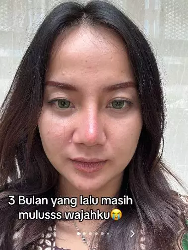 Wajah cewek beruntusan akibat salah skincare malah makin parah usai treatment TikTok Wajah cewek beruntusan akibat salah skincare malah makin parah usai treatment TikTok