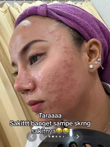 Wajah cewek beruntusan akibat salah skincare malah makin parah usai treatment TikTok Wajah cewek beruntusan akibat salah skincare malah makin parah usai treatment TikTok