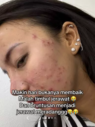 Wajah cewek beruntusan akibat salah skincare malah makin parah usai treatment TikTok Wajah cewek beruntusan akibat salah skincare malah makin parah usai treatment TikTok