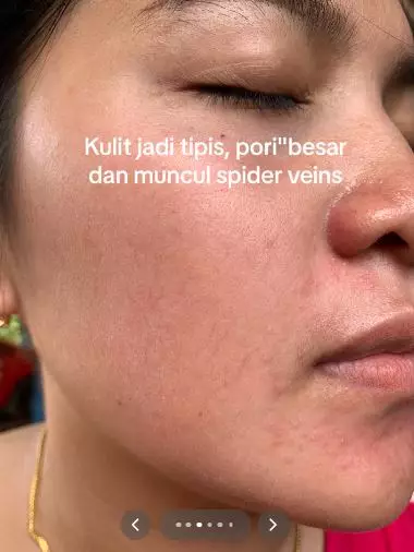 Kisah cewek niat cantik pakai krim dokter malah berakhir nyesek TikTok