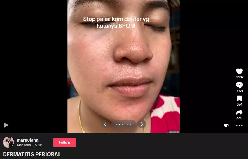 Kisah cewek niat cantik pakai krim dokter malah berakhir nyesek TikTok