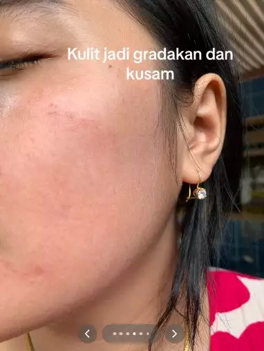 Kisah cewek niat cantik pakai krim dokter malah berakhir nyesek TikTok