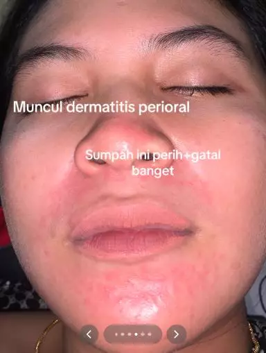 Kisah cewek niat cantik pakai krim dokter malah berakhir nyesek TikTok