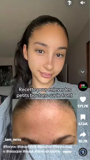 Kombinasi madu dan bahan dapur bisa atasi beruntusan di dahi Berbagai sumber