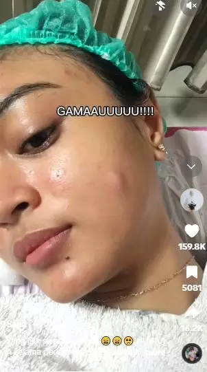 Kisah cewek pakai acne patch untuk atasi jerawat berujung pipi bolong TikTok Kisah cewek pakai acne patch untuk atasi jerawat berujung pipi bolong TikTok
