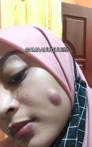 Kisah cewek pakai acne patch untuk atasi jerawat berujung pipi bolong TikTok Kisah cewek pakai acne patch untuk atasi jerawat berujung pipi bolong TikTok