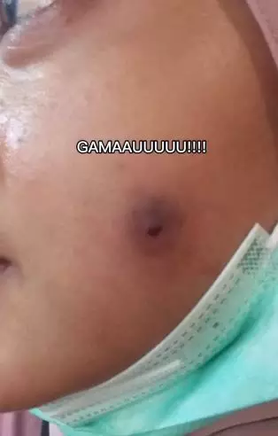 Kisah cewek pakai acne patch untuk atasi jerawat berujung pipi bolong TikTok Kisah cewek pakai acne patch untuk atasi jerawat berujung pipi bolong TikTok