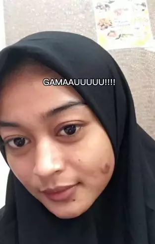 Kisah cewek pakai acne patch untuk atasi jerawat berujung pipi bolong TikTok Kisah cewek pakai acne patch untuk atasi jerawat berujung pipi bolong TikTok