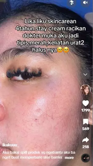 Kisah wanita lepas dari krim dokter wajah tipis berurat jadi sehat kembali TikTok Kisah wanita lepas dari krim dokter wajah tipis berurat jadi sehat kembali TikTok