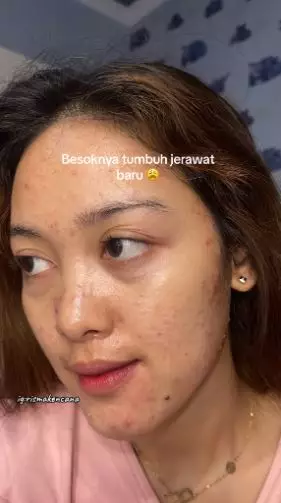 Kisah cewek sembuh dari jerawat rutin treatment endingnya zonk TikTok Kisah cewek sembuh dari jerawat rutin treatment endingnya zonk TikTok