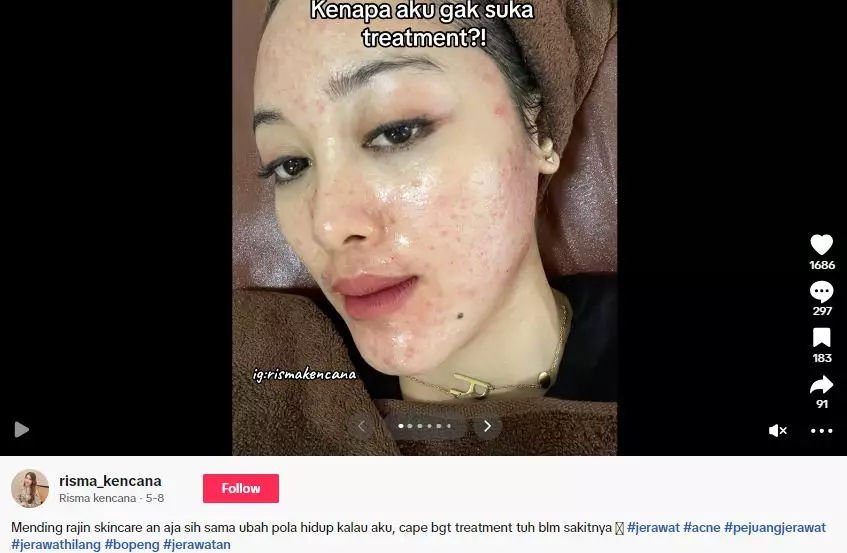 Kisah cewek sembuh dari jerawat rutin treatment endingnya zonk TikTok Kisah cewek sembuh dari jerawat rutin treatment endingnya zonk TikTok