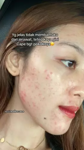 Kisah cewek sembuh dari jerawat rutin treatment endingnya zonk TikTok Kisah cewek sembuh dari jerawat rutin treatment endingnya zonk TikTok