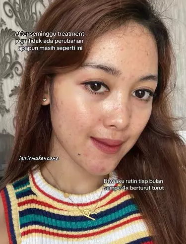 Kisah cewek sembuh dari jerawat rutin treatment endingnya zonk TikTok Kisah cewek sembuh dari jerawat rutin treatment endingnya zonk TikTok
