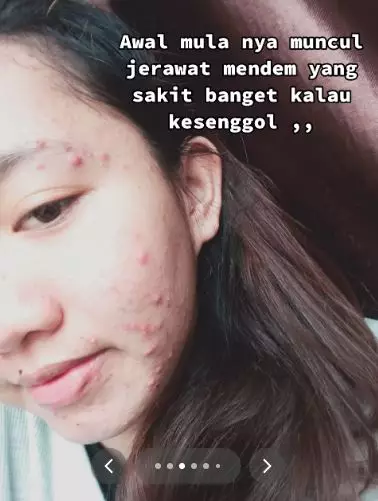 Kisah cewek alami breakout akibat salah pakai produk eksfoliasi TikTok Kisah cewek alami breakout akibat salah pakai produk eksfoliasi TikTok
