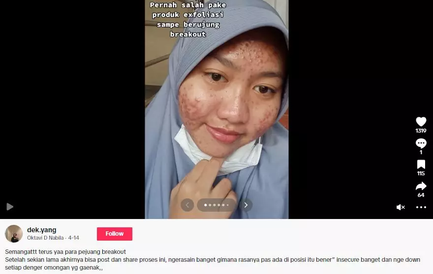 Kisah cewek alami breakout akibat salah pakai produk eksfoliasi TikTok Kisah cewek alami breakout akibat salah pakai produk eksfoliasi TikTok