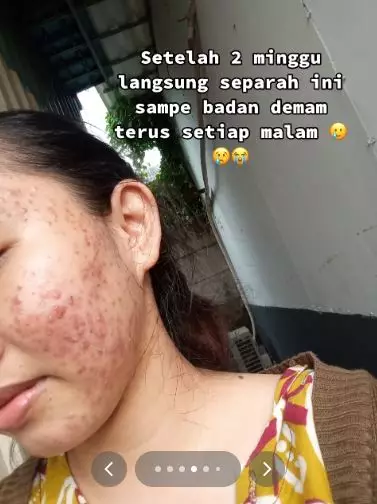 Kisah cewek alami breakout akibat salah pakai produk eksfoliasi TikTok Kisah cewek alami breakout akibat salah pakai produk eksfoliasi TikTok