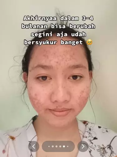 Kisah cewek alami breakout akibat salah pakai produk eksfoliasi TikTok Kisah cewek alami breakout akibat salah pakai produk eksfoliasi TikTok