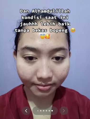 Kisah cewek alami breakout akibat salah pakai produk eksfoliasi TikTok Kisah cewek alami breakout akibat salah pakai produk eksfoliasi TikTok