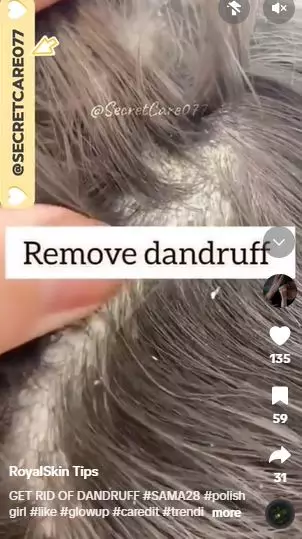 Baking soda dicampur 2 bahan dapur bisa atasi ketombe membandel Berbagai sumber