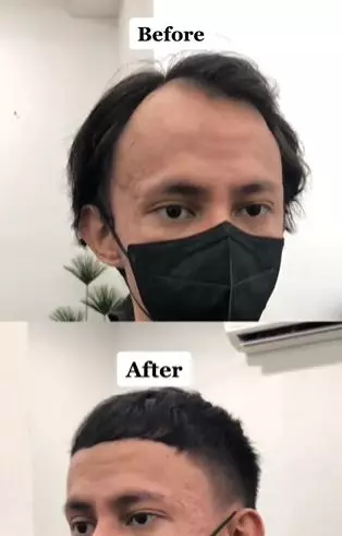 Pria rambut tipis dan botak M usai di styling bak pakai fake hair TikTok