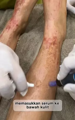 Kisah cewek kulit jadi rusak akibat HB Dosting abal-abal TikTok