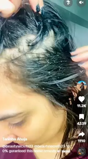 Coconut oil dicampur 1 jenis buah bisa atasi ketombe dalam sekali pakai Berbagai sumber