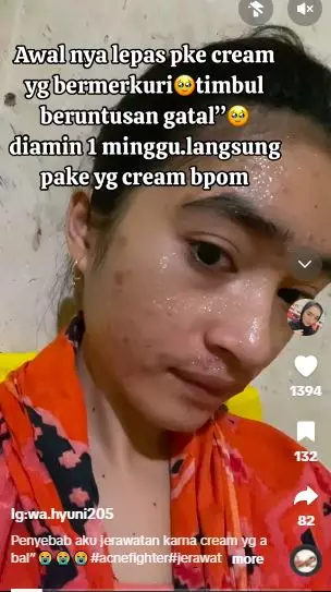 Kisah cewek korban krim abal-abal merkuri kondisi wajahnya bikin nyesek TikTok