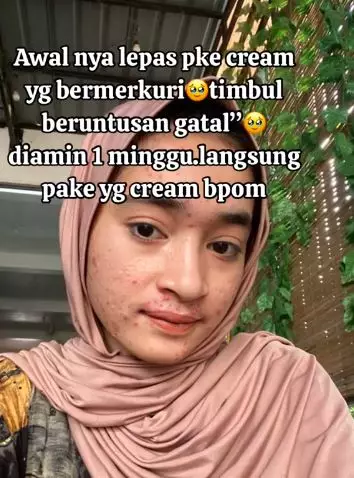 Kisah cewek korban krim abal-abal merkuri kondisi wajahnya bikin nyesek TikTok