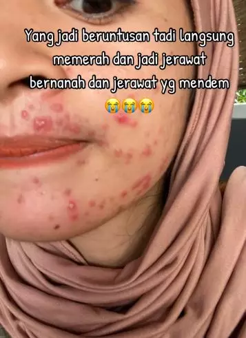 Kisah cewek korban krim abal-abal merkuri kondisi wajahnya bikin nyesek TikTok