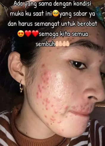 Kisah cewek korban krim abal-abal merkuri kondisi wajahnya bikin nyesek TikTok