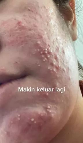 Efek pakai krim etiket biru berujung bikin wajah rusak TikTok