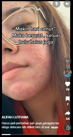 Efek pakai krim etiket biru berujung bikin wajah rusak TikTok