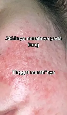 Efek pakai krim etiket biru berujung bikin wajah rusak TikTok