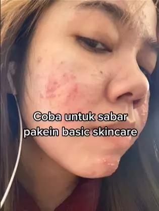 Efek pakai krim etiket biru berujung bikin wajah rusak TikTok