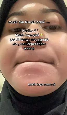 Kisah cewek pakai krim racikan dokter malah berujung menyesal TikTok