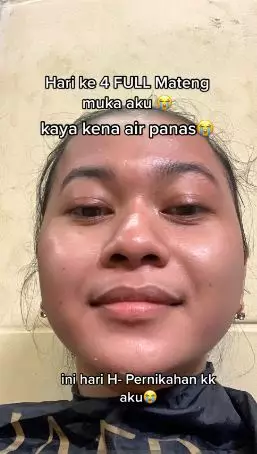 Kisah cewek pakai krim racikan dokter malah berujung menyesal TikTok
