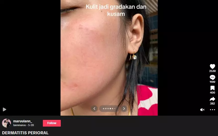Efek pakai krim dokter malah berujung nyesek jadi alami penyakit kulit TikTok Efek pakai krim dokter malah berujung nyesek jadi alami penyakit kulit TikTok