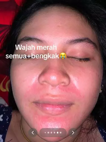 Efek pakai krim dokter malah berujung nyesek jadi alami penyakit kulit TikTok Efek pakai krim dokter malah berujung nyesek jadi alami penyakit kulit TikTok