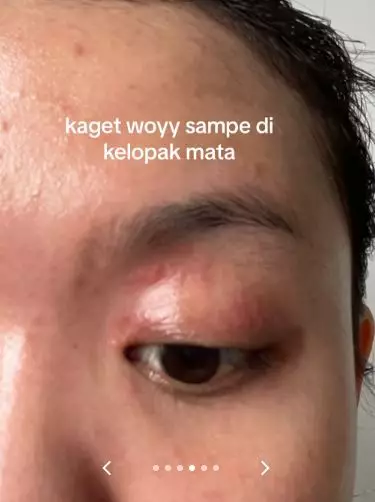 Akibat nggak rutin pakai krim etiket biru berujung kemerahan hampir seluruh wajah TikTok Akibat nggak rutin pakai krim etiket biru berujung kemerahan hampir seluruh wajah TikTok