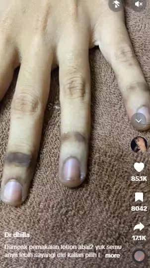 Tangan cewek jadi gosong akibat HB Dosting abal-abal TikTok Tangan cewek jadi gosong akibat HB Dosting abal-abal TikTok