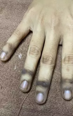 Tangan cewek jadi gosong akibat HB Dosting abal-abal TikTok Tangan cewek jadi gosong akibat HB Dosting abal-abal TikTok