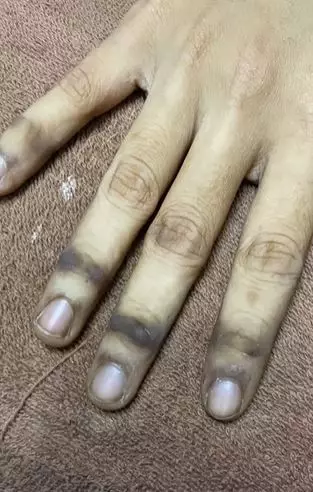 Tangan cewek jadi gosong akibat HB Dosting abal-abal TikTok Tangan cewek jadi gosong akibat HB Dosting abal-abal TikTok