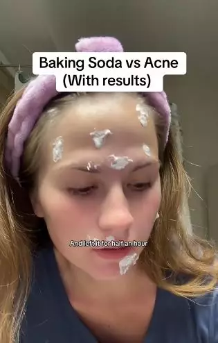 Bahan pembuat kue ternyata efektif bikin jerawat meradang cepat kering Berbagai sumber