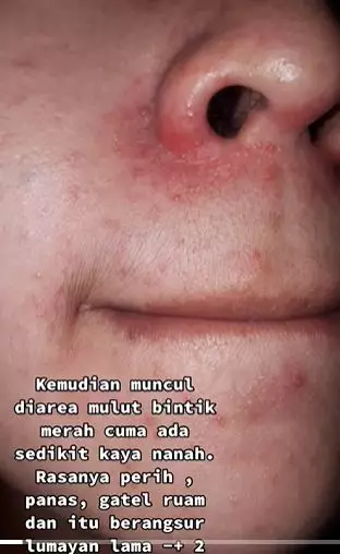 Efek pakai skincare kandungan steroid berujung alami penyakit kulit TikTok