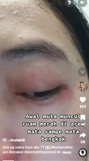Efek pakai skincare kandungan steroid berujung alami penyakit kulit TikTok