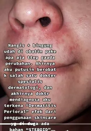 Efek pakai skincare kandungan steroid berujung alami penyakit kulit TikTok