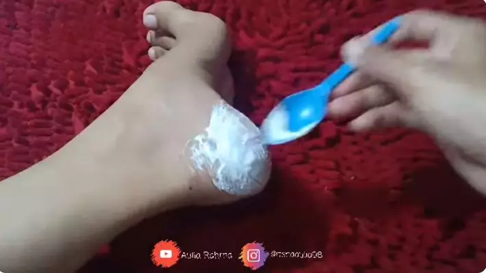 cara melembutkan tumit kaki pecah-pecah berbagai sumber