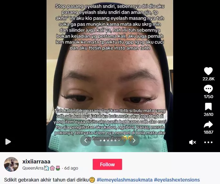 Efek pasang eyelash sendiri berujung kornea luka TikTok Efek pasang eyelash sendiri berujung kornea luka TikTok